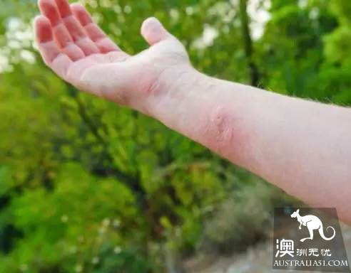 太毒了!澳洲男修剪草坪时,突然浑身肿胀命丧黄泉!我们后院里竟暗藏澳洲第一杀手!