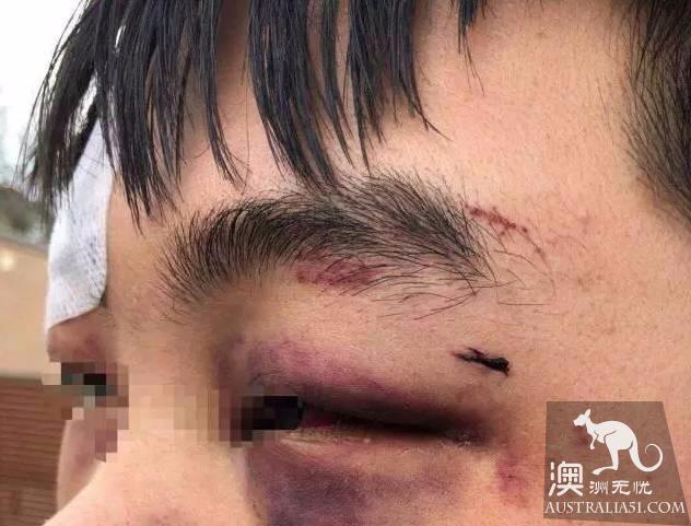 突发!中国留学生遭本地人暴力围殴致浑身是血,因拒绝给烟