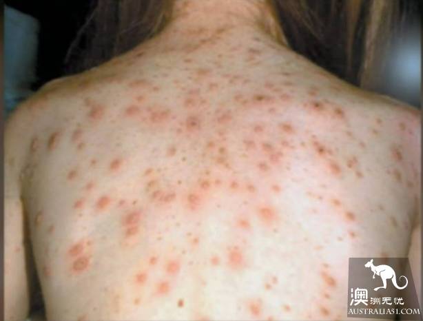 悉尼圣诞现麻疹病例，患者曾访CBD闹市